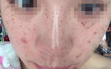 容易与雀斑混淆的皮肤病