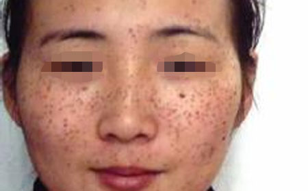 治疗雀斑的误区介绍
