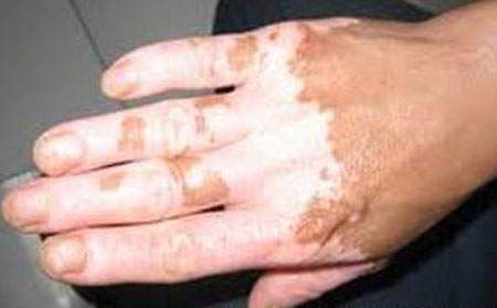 白癜风患者生活注意细节