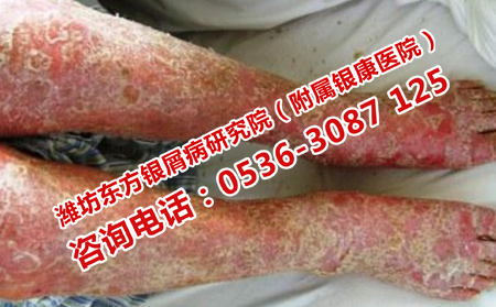 皮肤瘙痒如何治疗