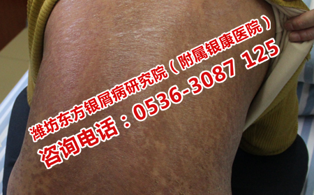 银屑病独有的症状