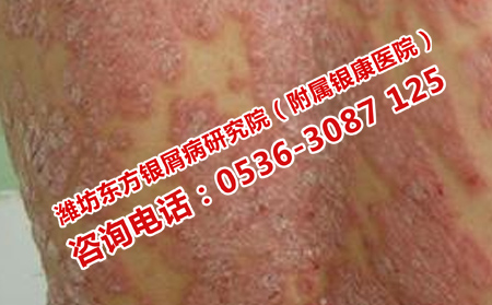 乙双吗啉治疗银屑病