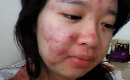 咨询皮肤病医生青春痘的问题