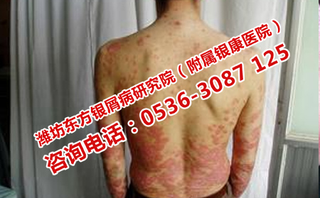 预防银屑病的可以方法