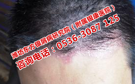 银屑病该怎么护理