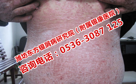 潍坊皮肤病医院治疗全身银屑病