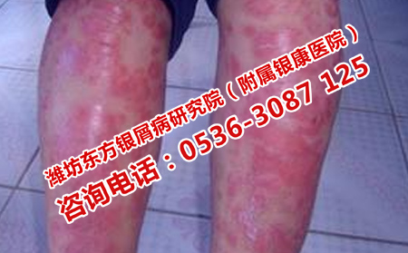潍坊可以的银屑病医院