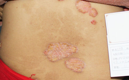 夏季皮肤病的防治