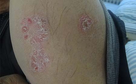 秋季湿疹的治疗