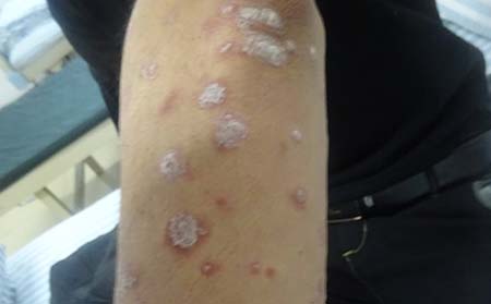 不见到效果银屑病继续治疗吗