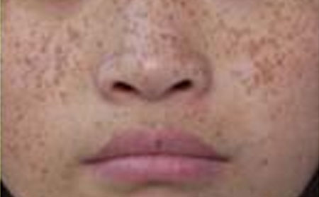 发生雀斑的原因有什么