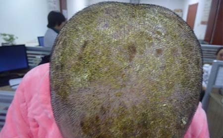 银屑病患者应该怎么进行护理