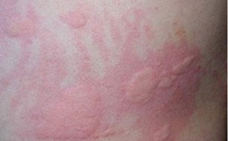 荨麻疹应该怎么护理