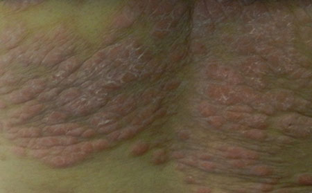 银屑病患者应该怎么注意饮食