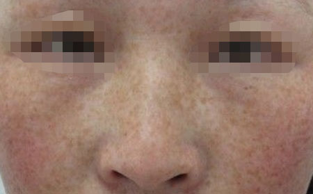 雀斑应该怎么护理