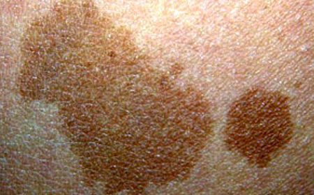 潍坊黄褐斑应该怎么护理