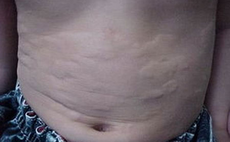 潍坊荨麻疹的护理方法有什么