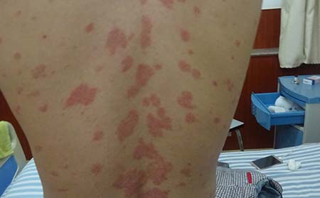 寻常型银屑病在潍坊怎么护理