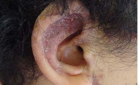 头部银屑病在潍坊怎么护理