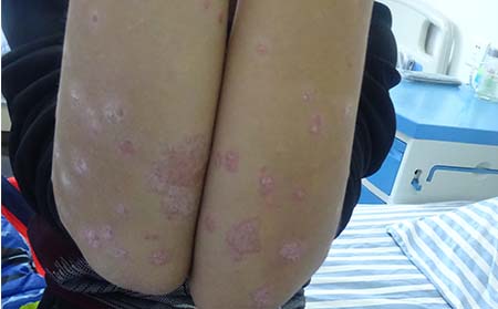 潍坊哪家医院看银屑病疗效好寻常型银屑病能好吗